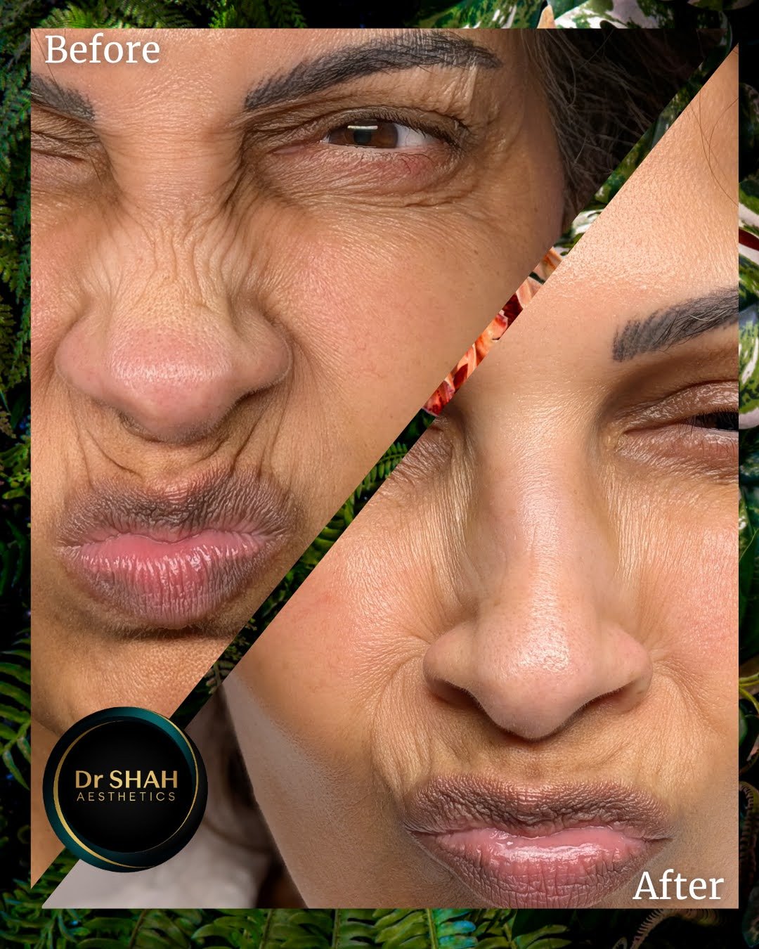 Before and after photos showing a reduction in bunny lines on the nose following anti-wrinkle treatment at Dr Shah Aesthetics
