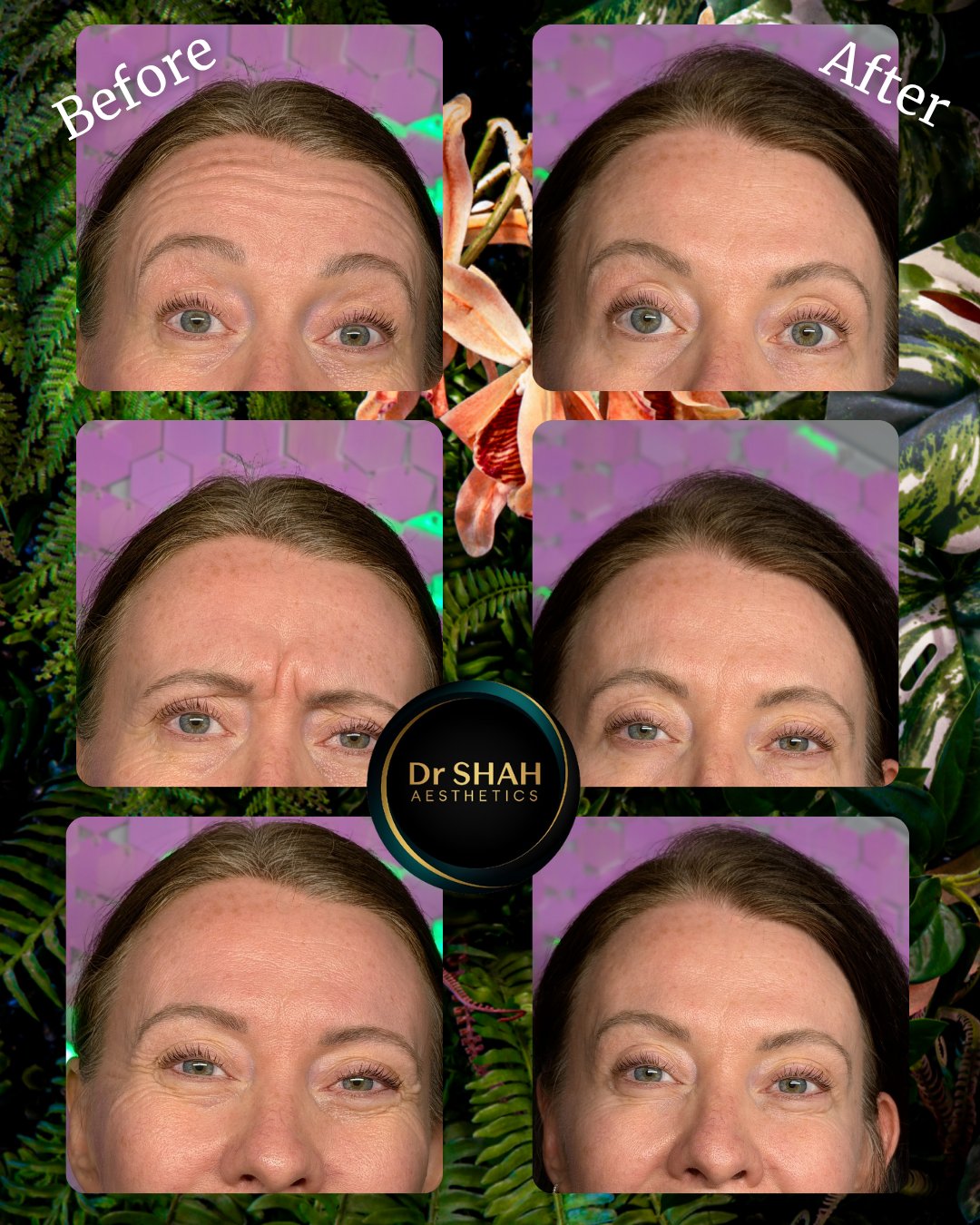 Before and after photos of forehead lines, frown lines and crow's feet softened with anti-wrinkle treatment at Dr Shah Aesthetics, patient 1