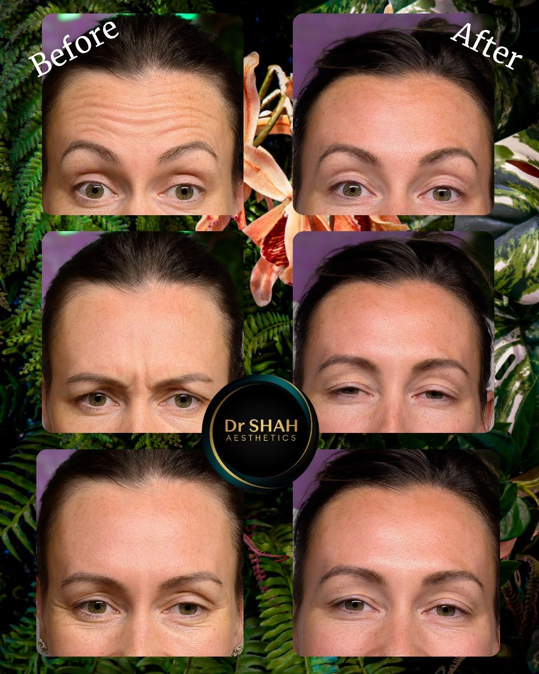 Before and after photos of forehead lines, frown lines and crow's feet softened with anti-wrinkle treatment at Dr Shah Aesthetics, patient 2