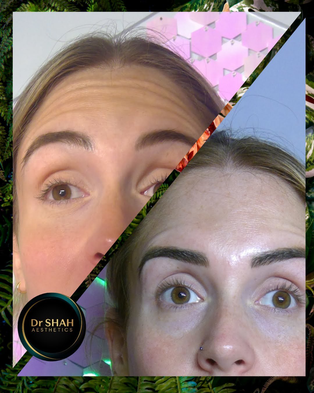 Before and after photos showing smoother forehead lines following anti-wrinkle treatment at Dr Shah Aesthetics