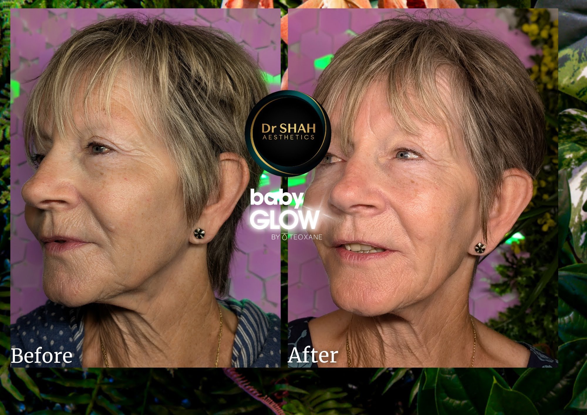 Before and after photos of skin quality and glow following Baby GLOW skin booster treatment at Dr Shah Aesthetics, angled view