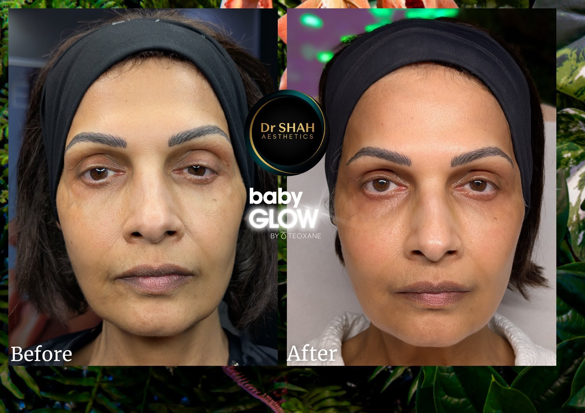 Before and after photos of skin quality and glow following Baby GLOW skin booster treatment at Dr Shah Aesthetics, front view