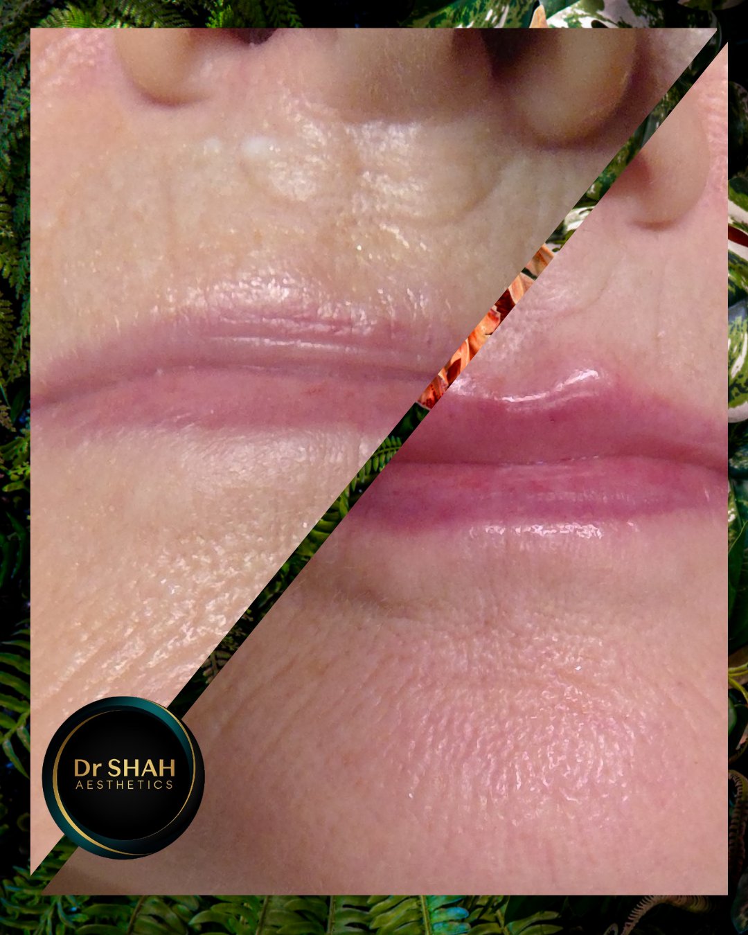 Before and after photos of a lip enhancement treatment at Dr Shah Aesthetics, patient 2
