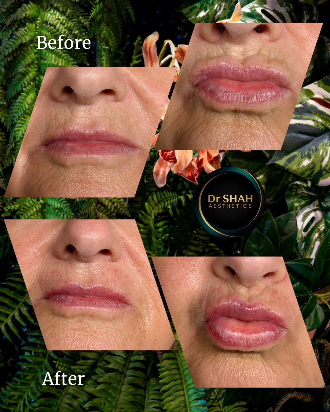 Before and after photos showing softer perioral lines around the mouth following treatment at Dr Shah Aesthetics